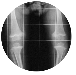 Image of an X-ray of someone with bone deformities
